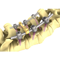 pine ii opfix plus脊柱內固定系統
