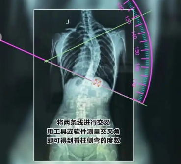 脊柱側(cè)彎輔助測量軟件gd-ais