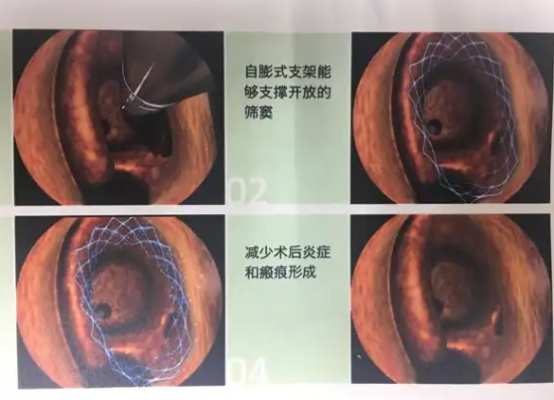 全降解鼻竇藥物支架系統bms014217ds01